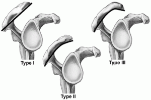 acromion types.jpg