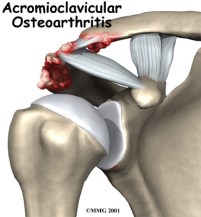 shoulder_acromioclavicular_arthrosis_intro01