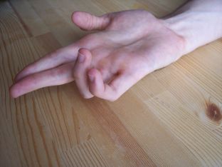 1024px-Ulnar_claw_hand